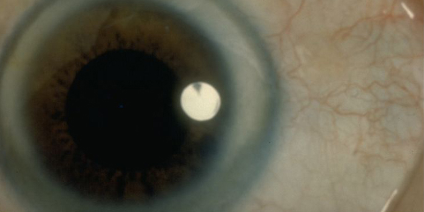 Close up of an eye with a bluish ring along the outer edge of the iris, called arcus senilis.