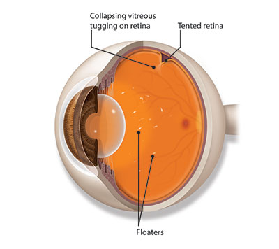 Illustration of debris inside the eye that causes people to see floaters in their vision