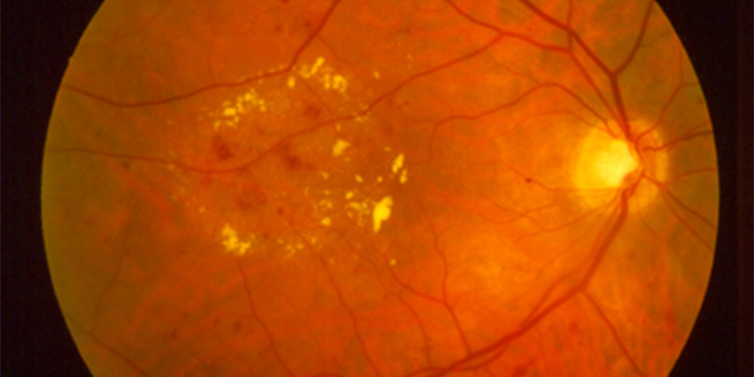 Exudados duros de la retinopatía diabética