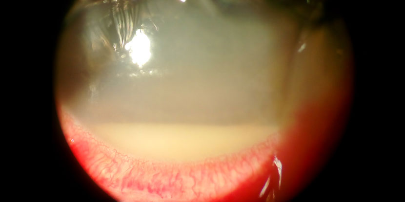 Hipopión, acumulación de glóbulos sanguíneos blancos en la parte anterior del ojo provenientes de endoftalmitis, como se ven a través de la lámpara de hendidura.