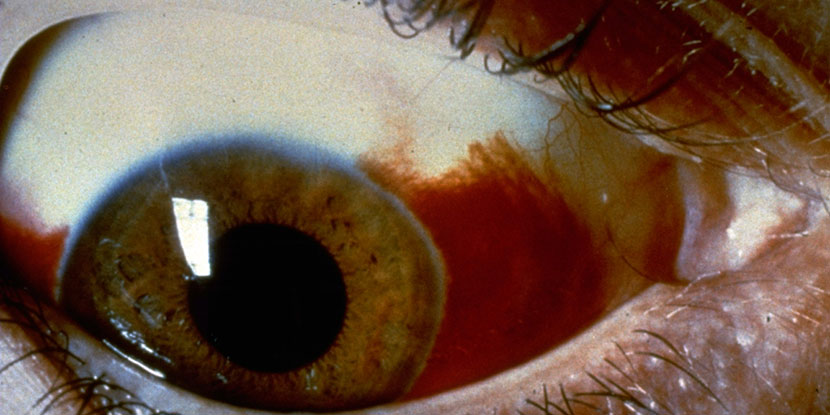 Photo of a subconjunctival hemorrhage, when one or more blood spots appear on the white of your eye.