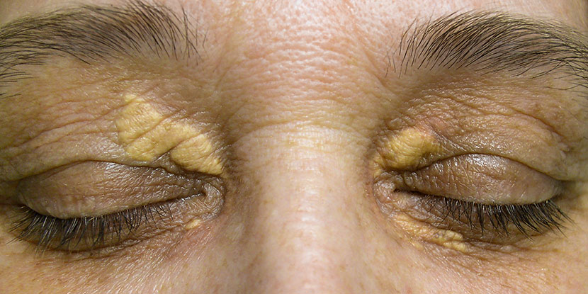Close up photograph of mature woman with xanthelasma or cholesterol deposits on eyelids.