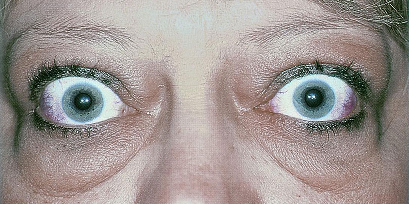 Tepezza ha sido aprobada como el primer tratamiento no quirúrgico para la enfermedad tiroidea del ojo