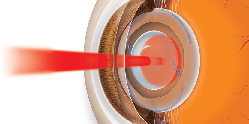 Con un láser se realiza una abertura en la cápsula del lente que se ha opacificado para restaurar una visión clara.