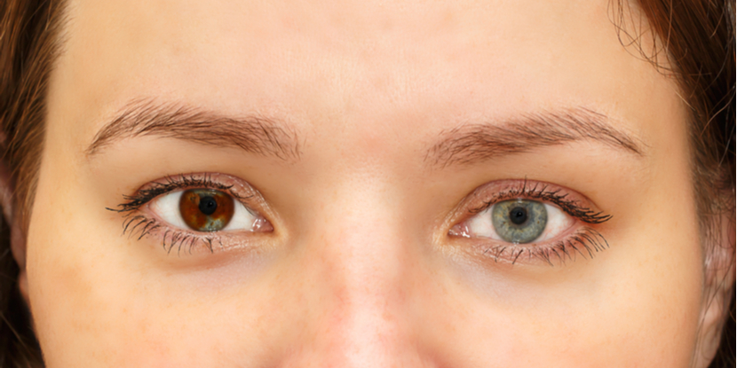 Woman with heterochromia or eyes with different colors