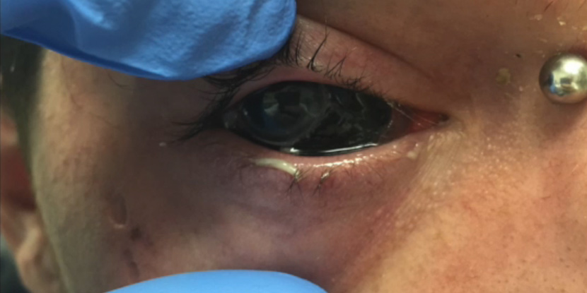 Pre-operative exam of patient who received a scleral tattoo.