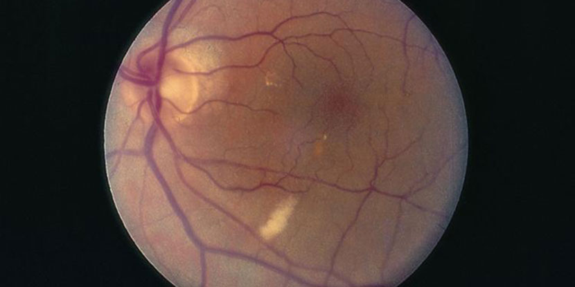 Doctors examine a so-called "cotton wool" spot in the retina.