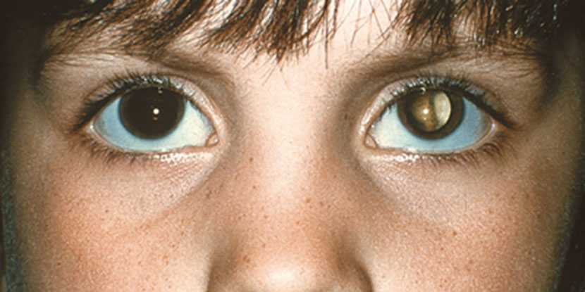 Niño con reflejo de ojo blanco del ojo izquierdo, que puede indicar la presencia de retinoblastoma
