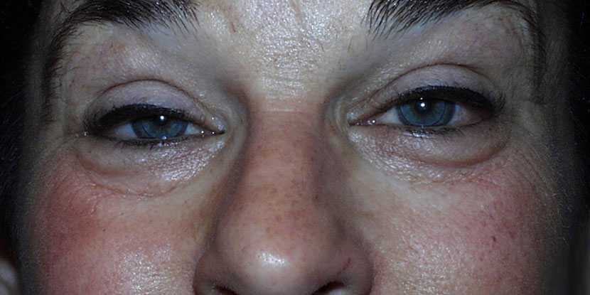 Mujer con ptosis o párpados caídos de ambos ojos