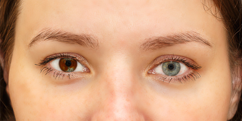 Imagen de primer plano de una mujer con heterocromia de iris - dos ojos de diferentes colores.