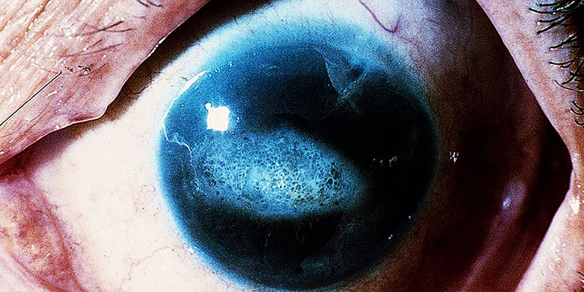Una imagen de un ojo azul con síndrome iridocorneal que muestra cambios y distorsiones en el iris, la parte coloreada del ojo