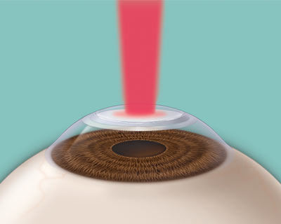 In photorefractive keratectomy surgery a laser removes tissue from the cornea to reshape it and sharpen vision.