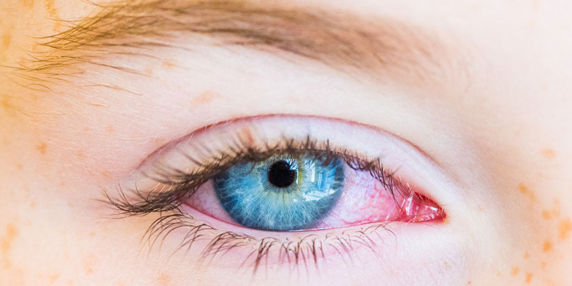 Get Rid Of Pink Eye Fast With These Home Remedies American Academy Of
