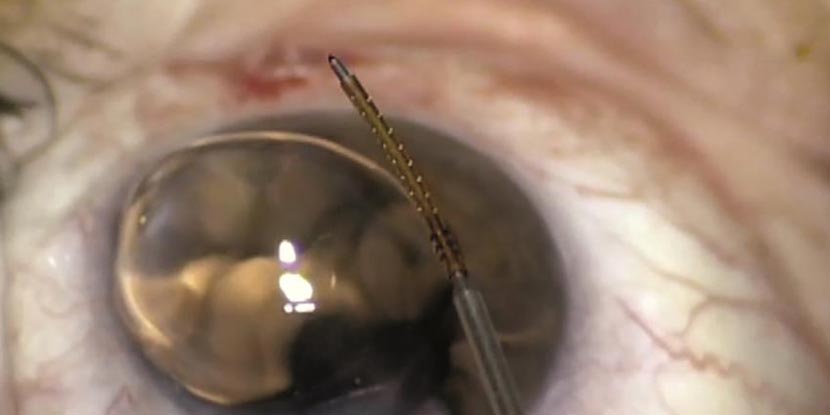 El Stent CyPass para el glaucoma de Alcon se muestra aquí con un instrumento quirúrgico antes de ser implantado en un ojo.