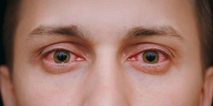 Fotografía de los ojos rojos e inflamados de un paciente