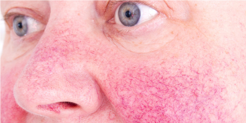La cara de una mujer está cubierta con una erupción roja causada por la rosácea.