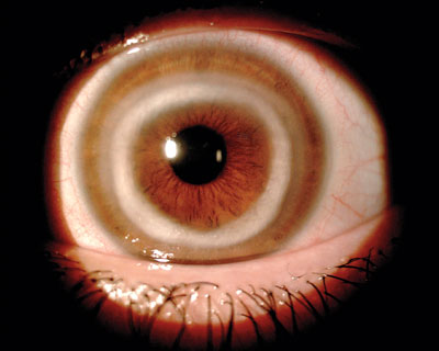 A white ring is seen on the cornea of a patient who was later diagnosed with Cogan's syndrome. Image courtesy of New England Journal of Medicine