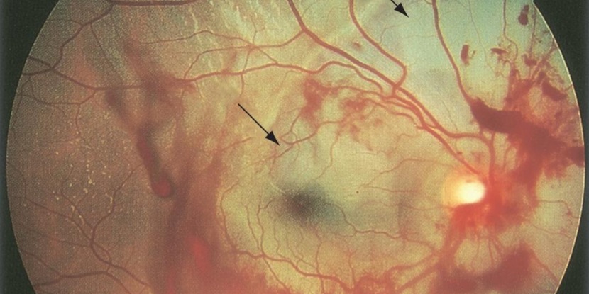 Imagen de un moretón en la retina