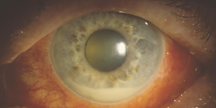 Uveitis increases risk of multiple sclerosis relapse - American Academy