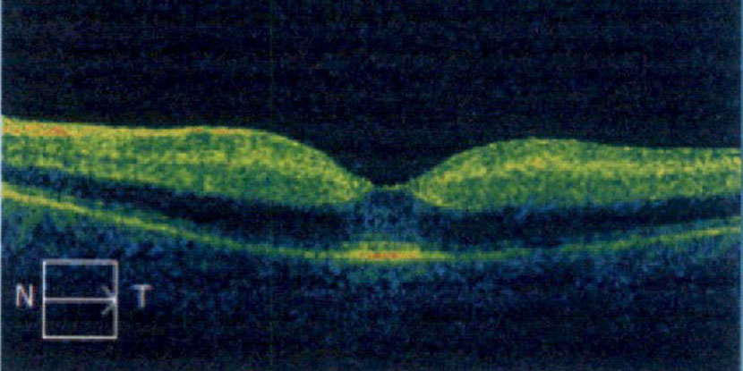OCT scan showing central retinal artery occlusion