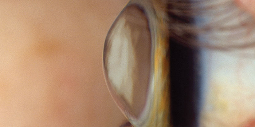 Image of an eye with keratoconus, or cone-shaped cornea