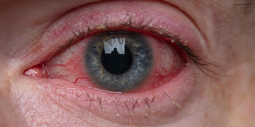 Close up of a man's red, watery, irritated eye