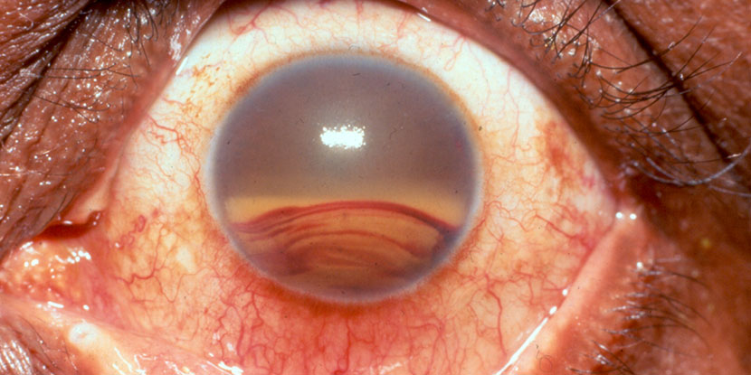 Una fotografía de un hifema, cuando la sangre se acumula dentro de la parte frontal del ojo.