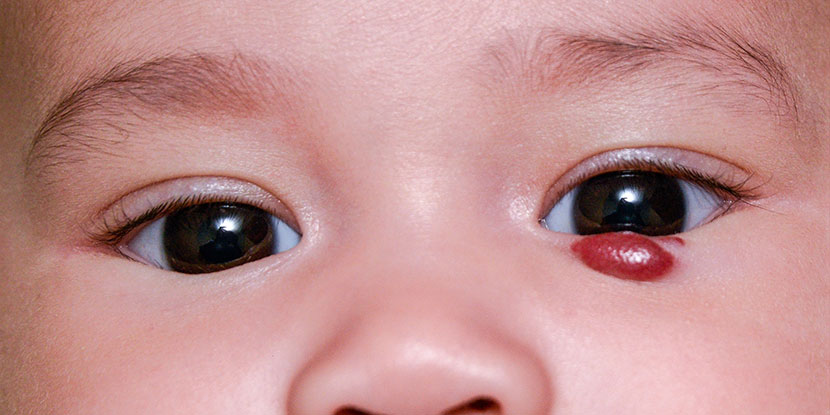 Una foto de un bebé con un hemangioma debajo de su ojo izquierdo. Un hemangioma es un tumor no canceroso (benigno) causado por un crecimiento anormal de los vasos sanguíneos.