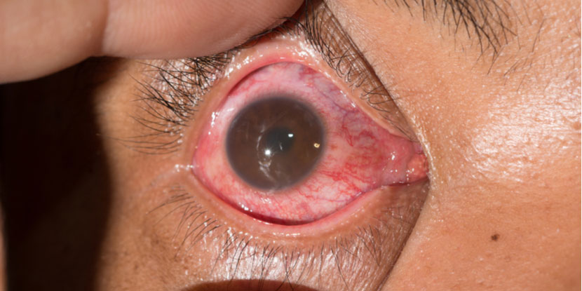 Primer plano de la uveítis anterior, o inflamación de la parte frontal del ojo