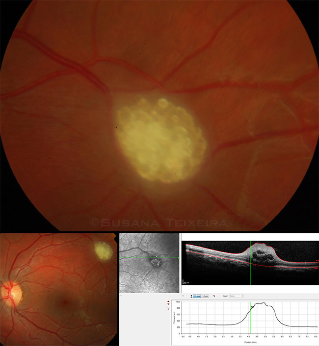 Retinal Astrocytoma