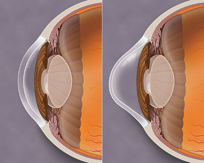Side-view Illustration of a normal cornea and a cone-shaped cornea with keratoconus