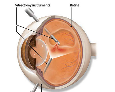 Retinal Detachment Diagnosis And Treatment American Academy Of
