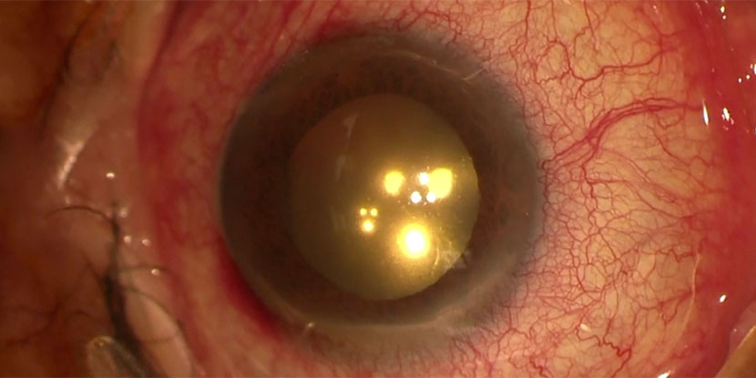 Pars Plana Vitrectomy after Pneumatic Retinopexy - American Academy of