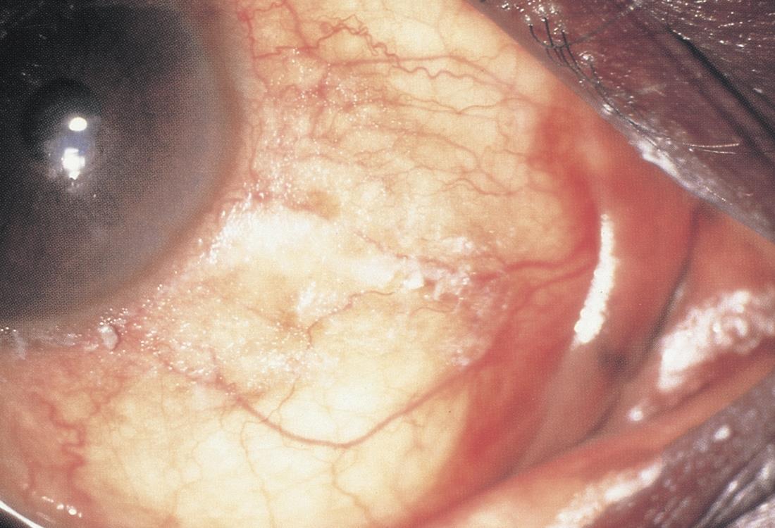 Conjunctival Xerosis American Academy Of Ophthalmology