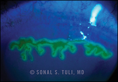 Geographic Ulcer in Epithelial Keratitis
