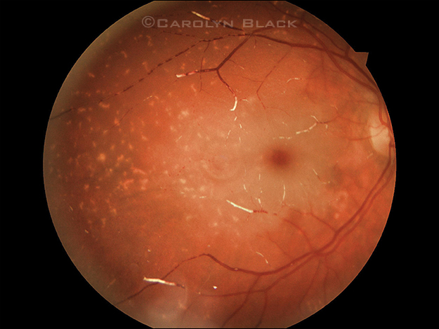 Central Retinal Artery Occlusion After Frontal Sinus Triamcinolone Injection