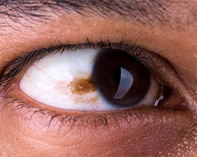This freckle of the eye is called a conjunctival nevus. The nevus is on the conjunctiva, a clear film that covers the white of the eye.