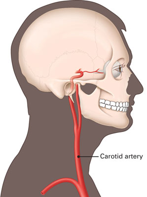 Diagram of Carotid arteries