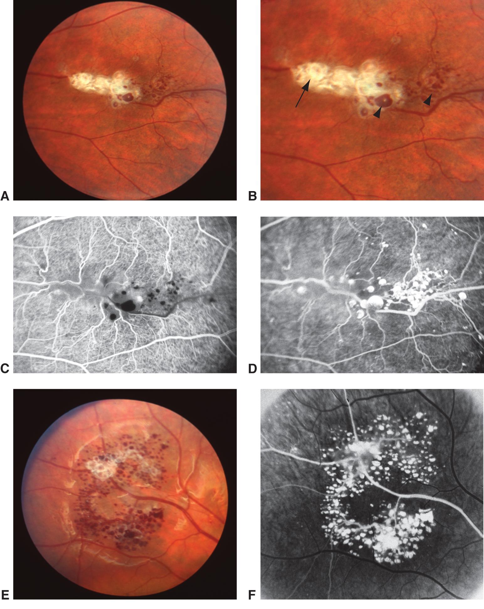 Retinal cavernous hemangioma - American Academy of Ophthalmology