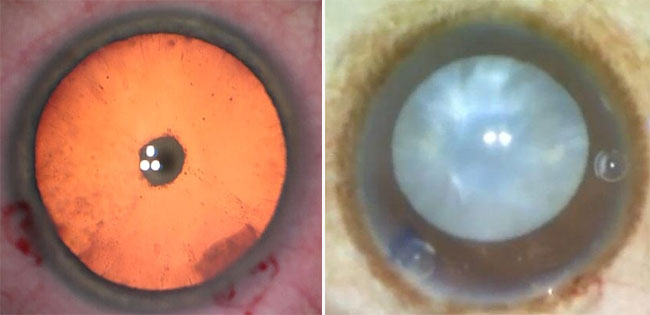 Figure 3. Posterior polar cataract (left) and a mature cataract (right).