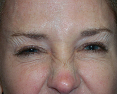 Fotografía de arrugas en la frente despues de la inyección de toxina botulínica