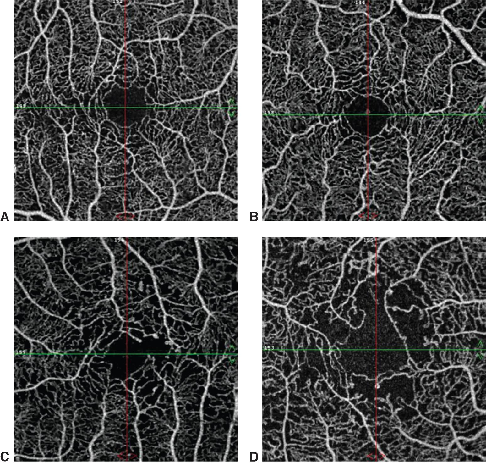 OCTA and diabetic retinopathy severity - American Academy of Ophthalmology