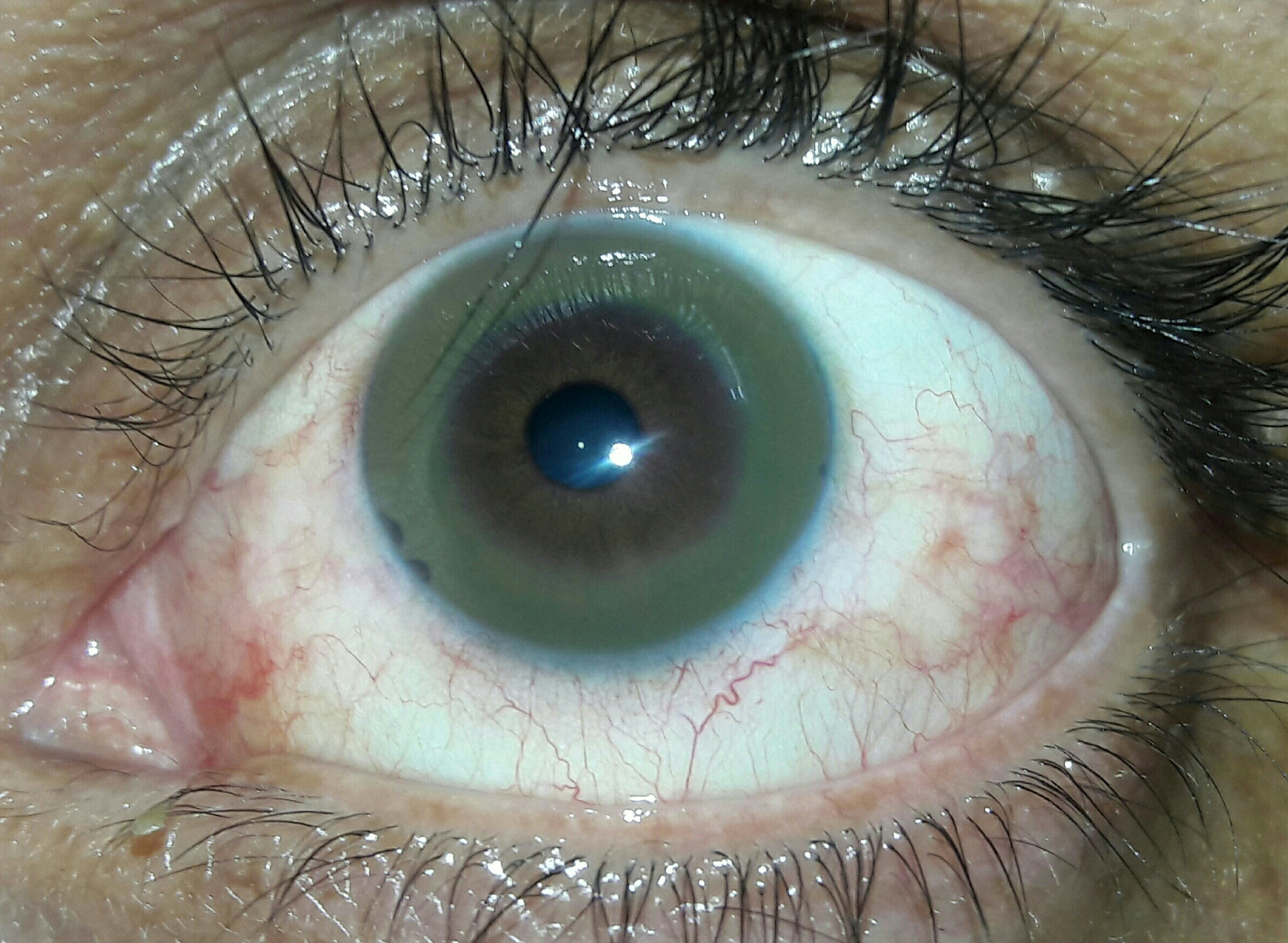 Kayser-Fleischer ring in eye due to liver disease - Stock 
