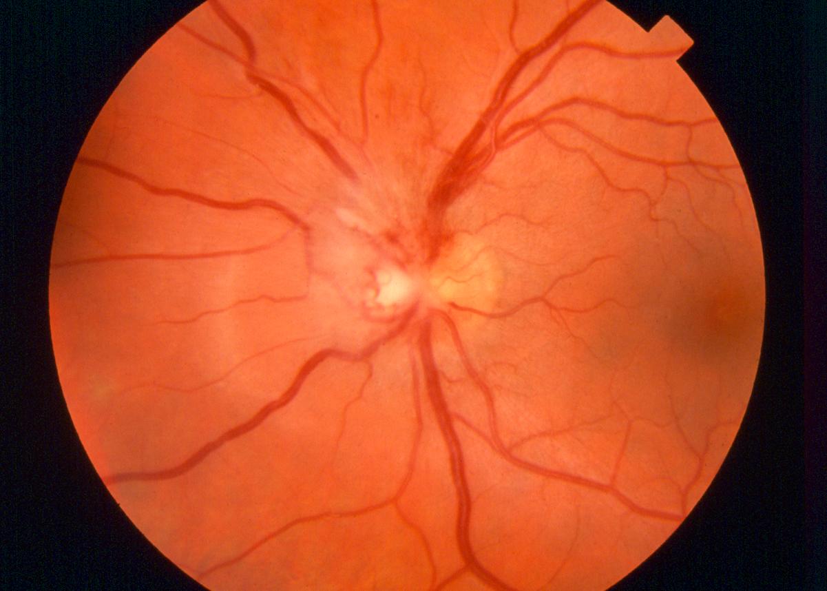 Передняя ишемическая нейропатия. Ишемическая нейропатия зрительного нерва. Передняя ишемическая нейропатия глазное дно. Задняя ишемическая оптическая нейропатия. Ишемическая нейропатия глаза.
