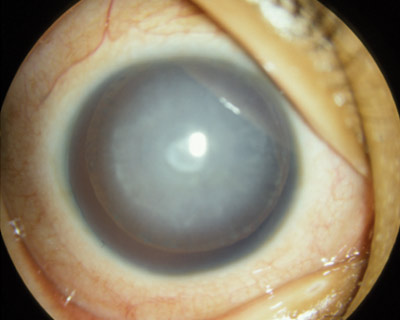 Pediatric cataract in the eye of a child born with aniridia (missing iris).