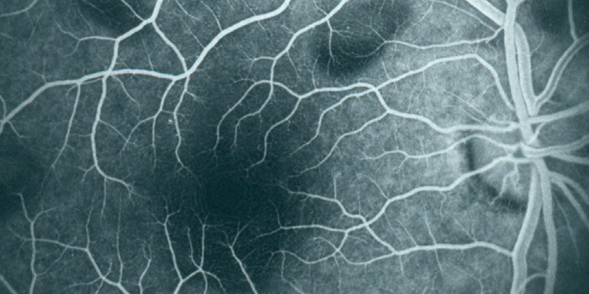 este posibilă îmbunătățirea hipermetropiei astigmatism și hipermetropie la un ochi