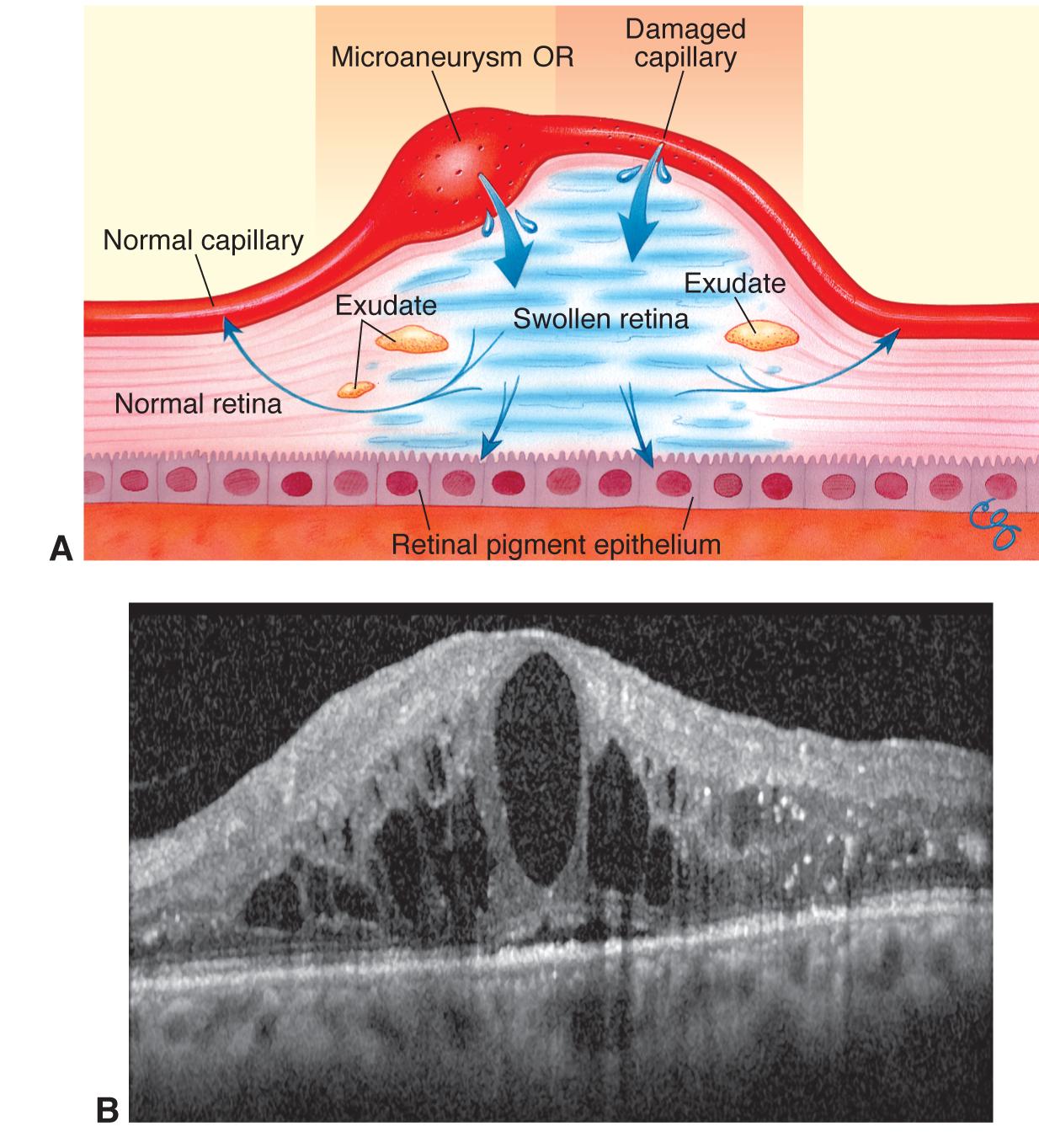 case study of diabetic macular edema