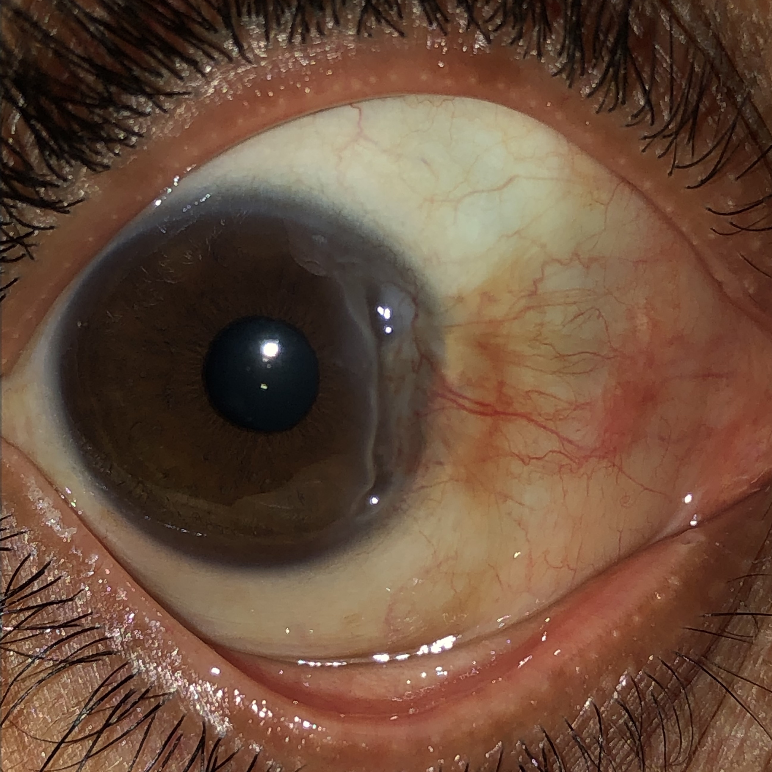 Peripheral corneal ulceration American Academy of Ophthalmology