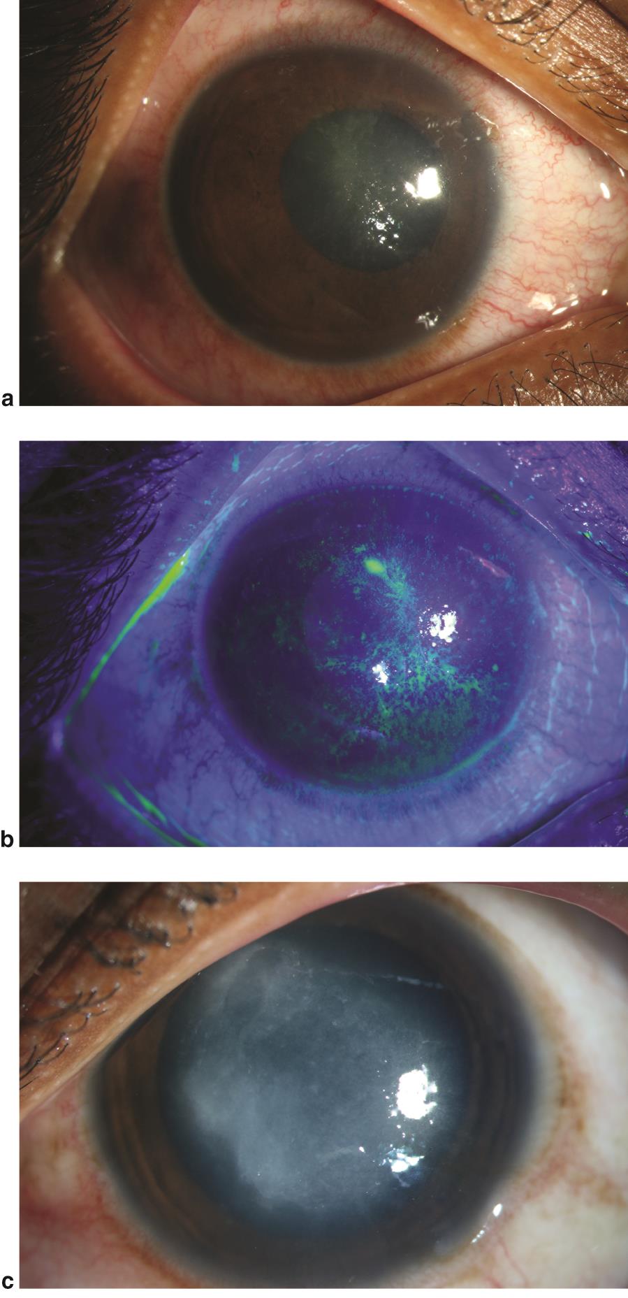 Early signs of Acanthamoeba keratitis - American Academy of Ophthalmology