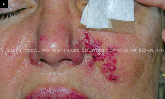 Bacterial Infection Complicating Hyaluronic Acid Filler Injection